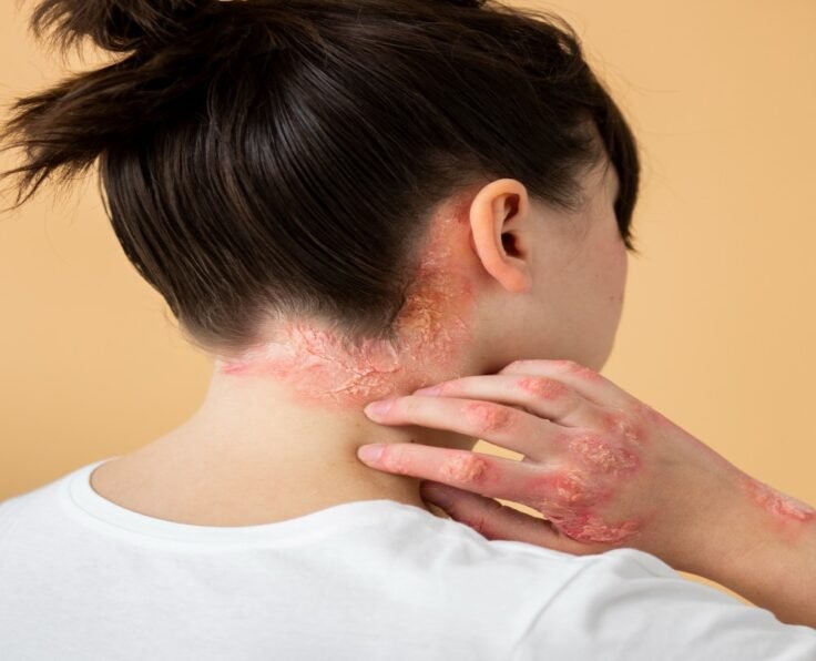 psoriasis-eczema-neck-patient (1)